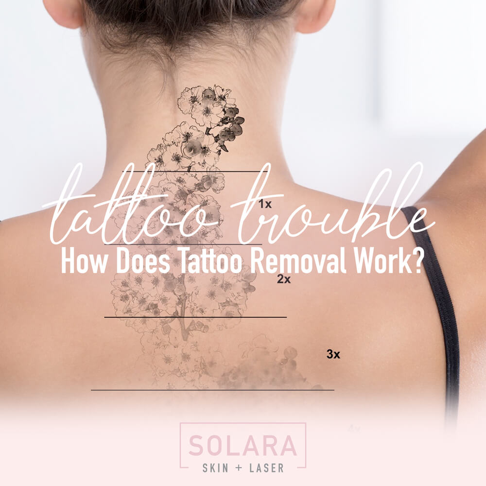 Tattoo Troubles: How Does Tattoo Removal Work?